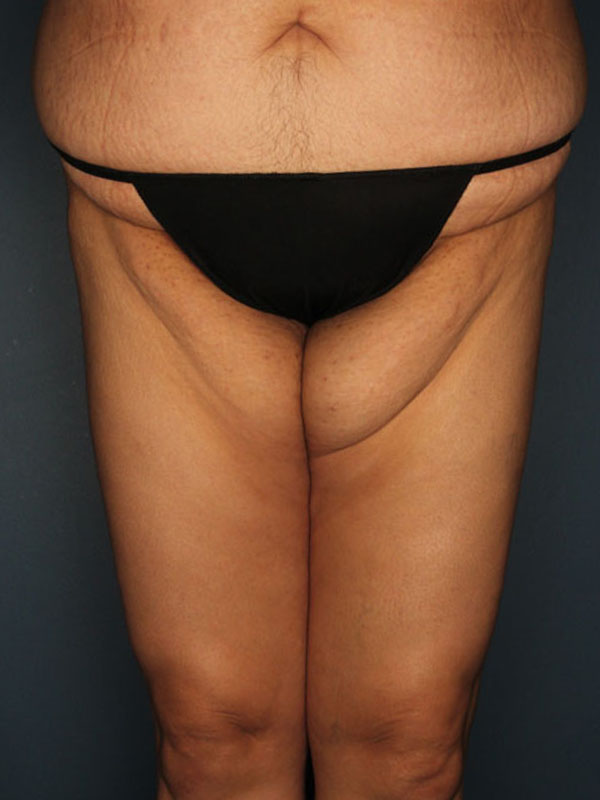 Case--39924 | Before Thigh Lift