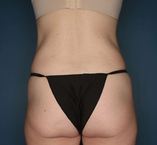 Case--36824 | After Liposuction