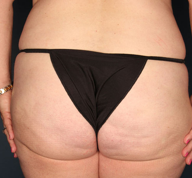Case--36924 | Before Liposuction