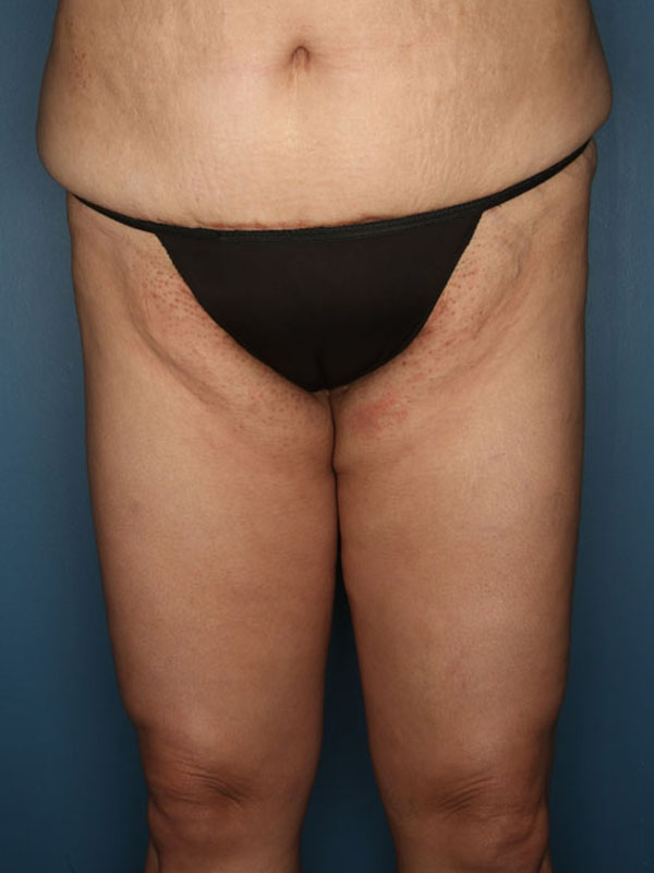 Case--39924 | After Thigh Lift