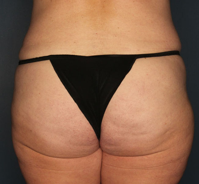 Case--36924 | After Liposuction