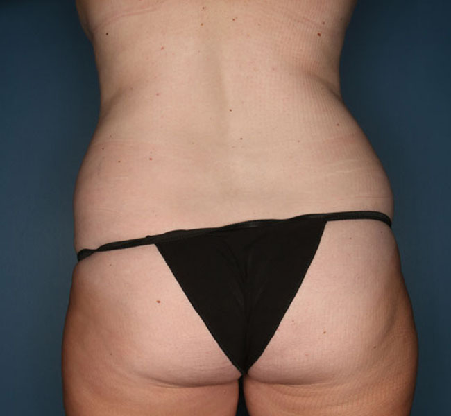Case--37024 | Before Liposuction