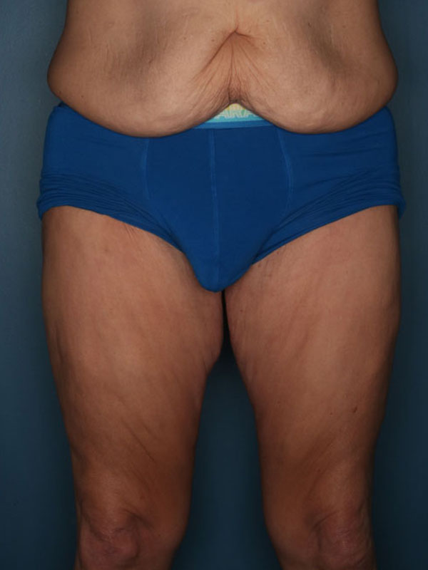 Case--40024 | Before Thigh Lift
