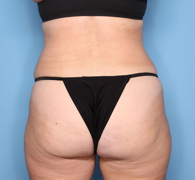 Case--37024 | After Liposuction