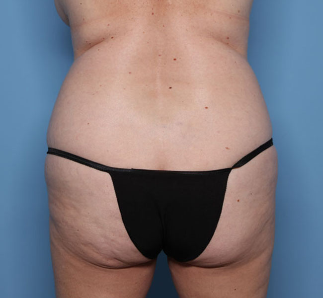 Case--37124 | Before Liposuction