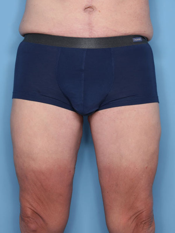 Case--40024 | After Thigh Lift