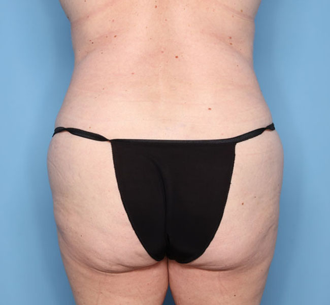 Case--37124 | After Liposuction