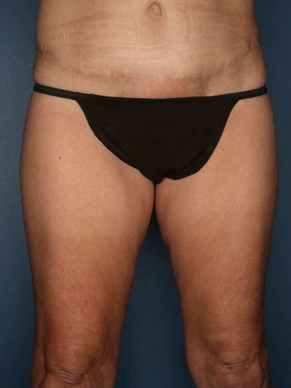 Case--40124 | Before Thigh Lift