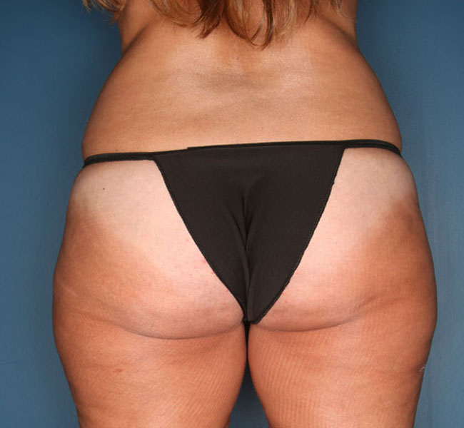 Case--37324 | Before Liposuction