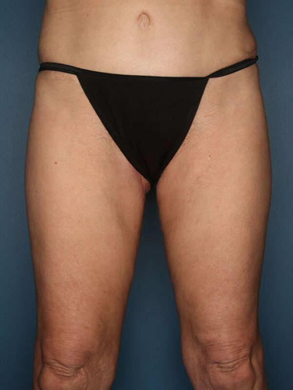 Case--40124 | After Thigh Lift