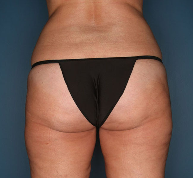 Case--37324 | After Liposuction