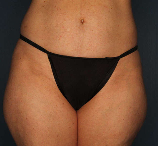 Case--37424 | Before Liposuction