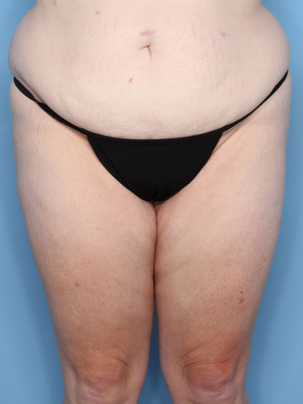 Case--40224 | Before Thigh Lift