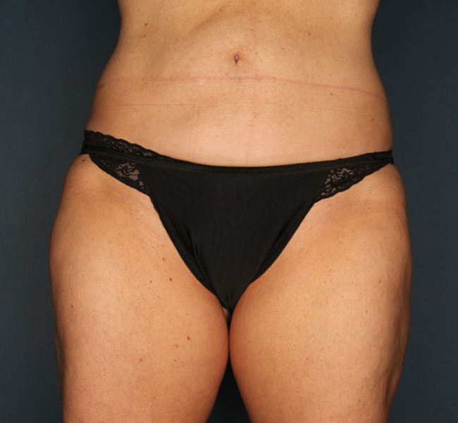 Case--37424 | After Liposuction