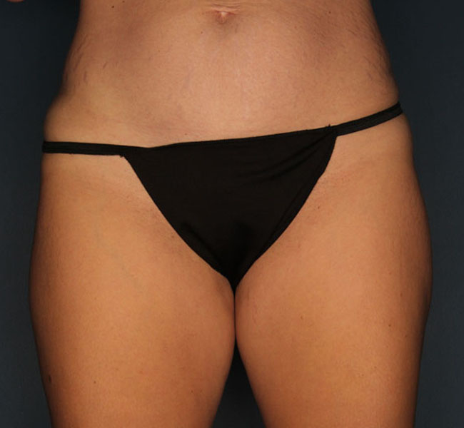 Case--37524 | Before Liposuction