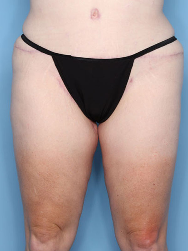 Case--40224 | After Thigh Lift