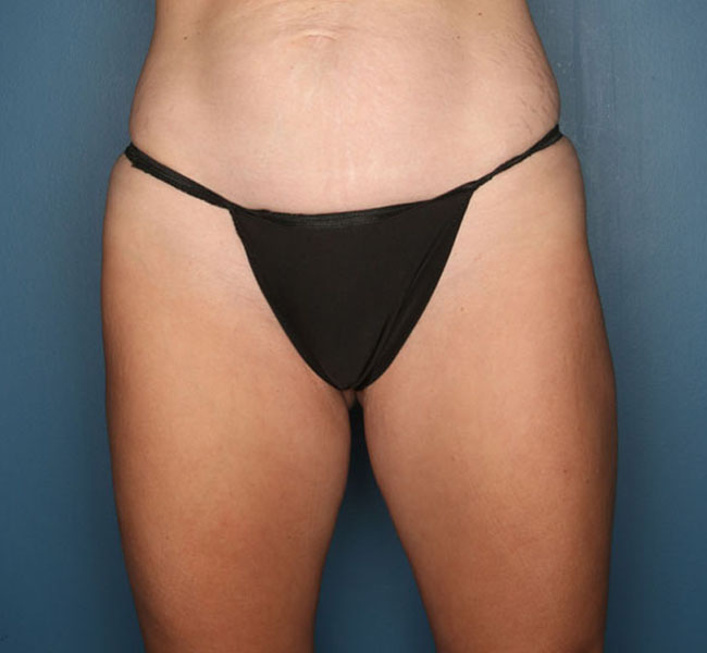 Case--37524 | After Liposuction