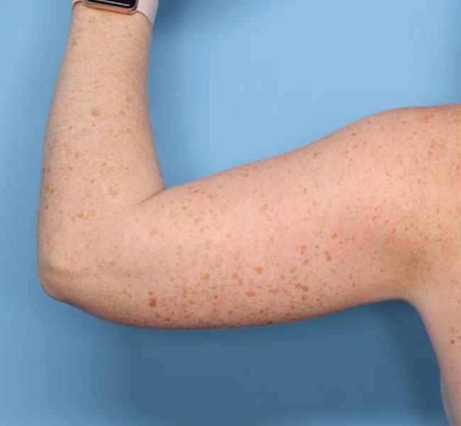 Case--37624 | Before Liposuction