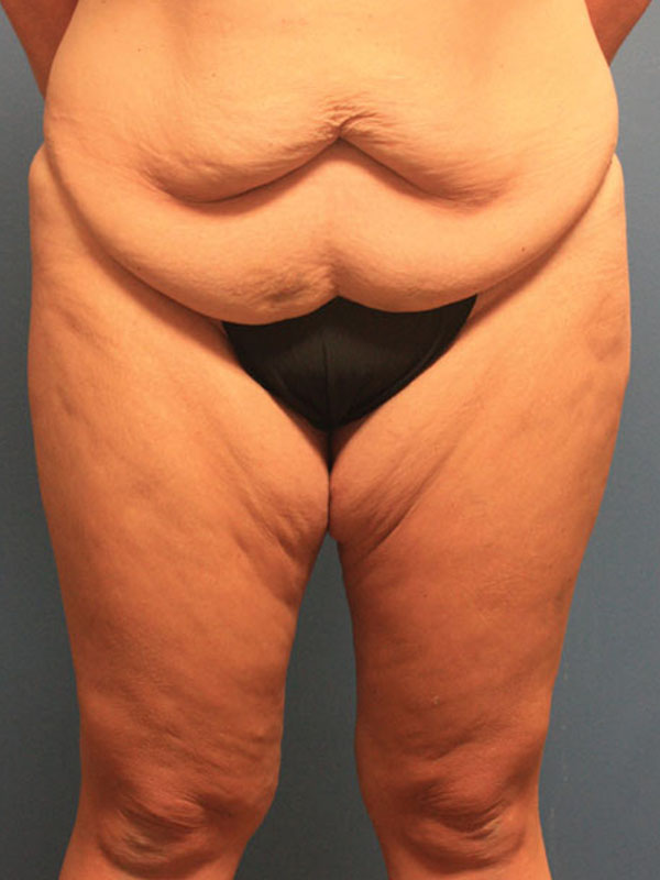 Case--40324 | Before Thigh Lift