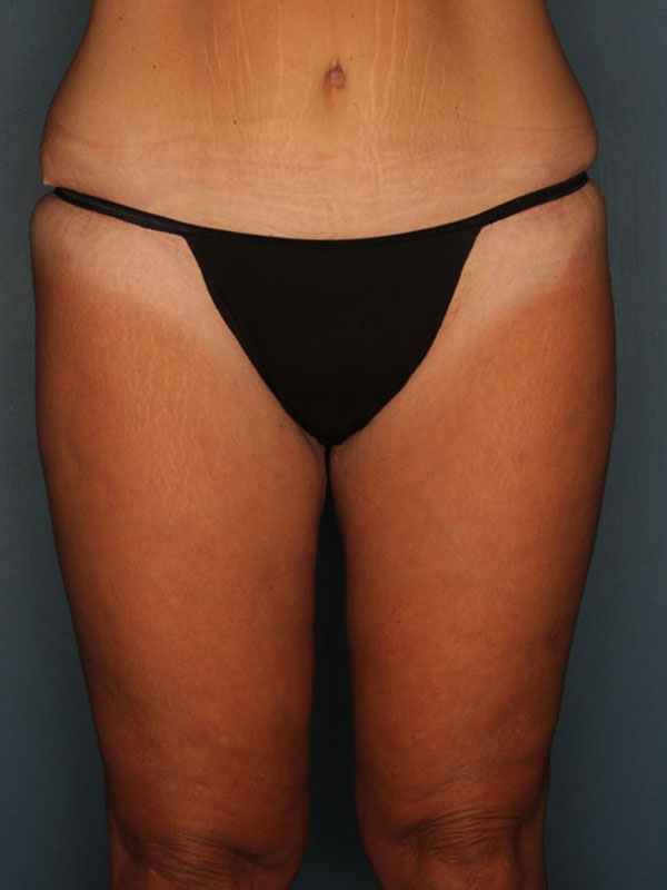 Case--40324 | After Thigh Lift