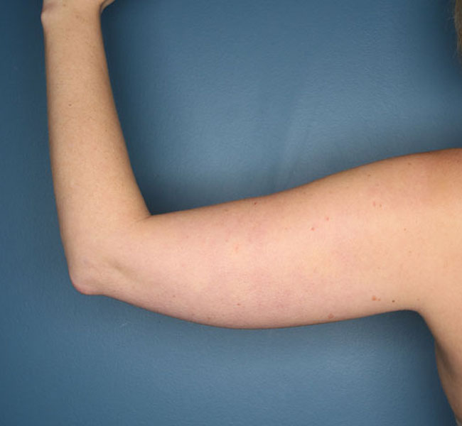 Case--37724 | Before Liposuction