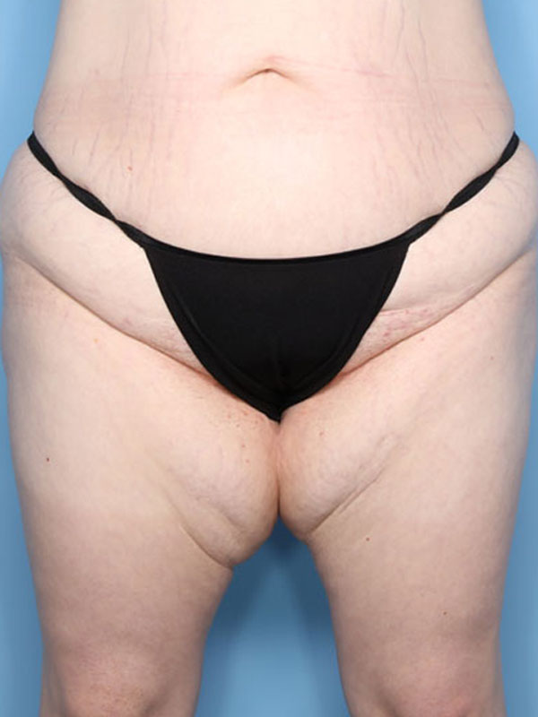 Case--40424 | Before Thigh Lift