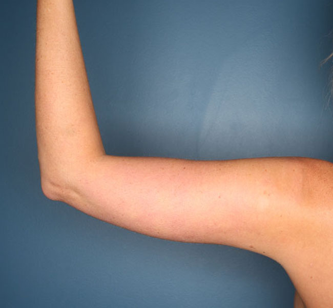 Case--37724 | After Liposuction