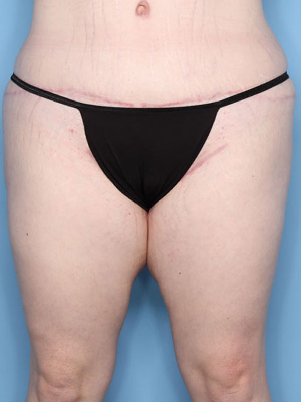 Case--40424 | After Thigh Lift