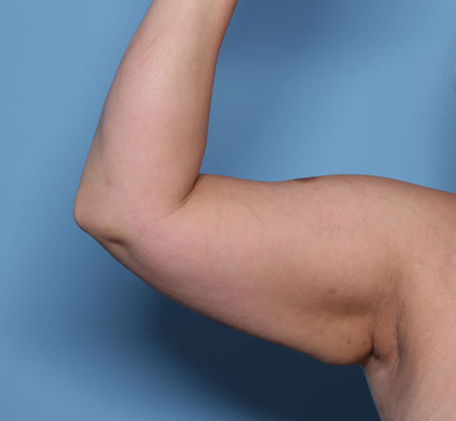 Case--37824 | Before Liposuction