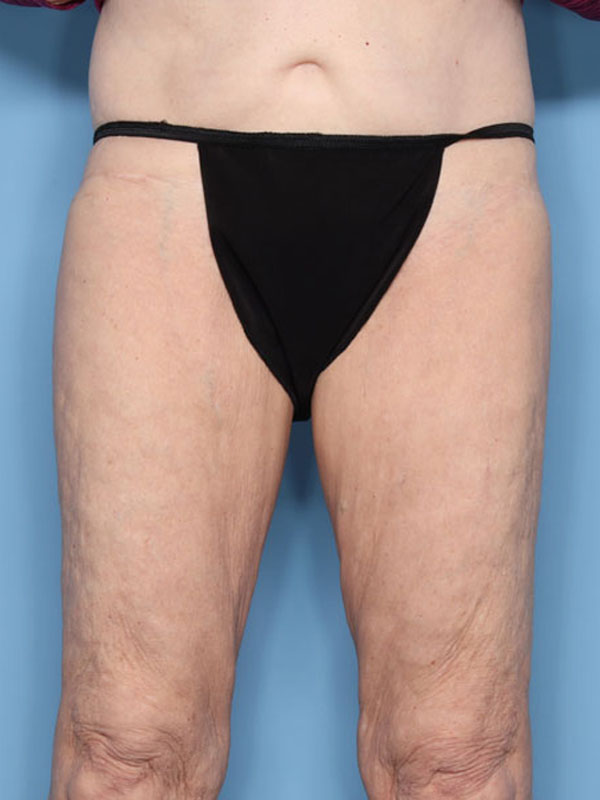 Case--40524 | Before Thigh Lift