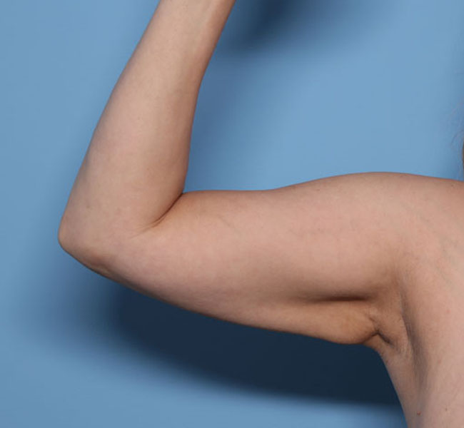 Case--37824 | After Liposuction