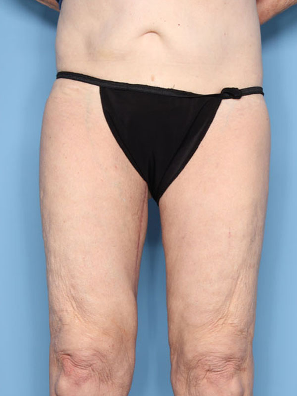 Case--40524 | After Thigh Lift
