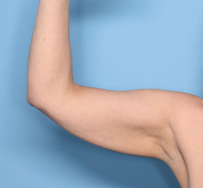 Case--37924 | Before Liposuction