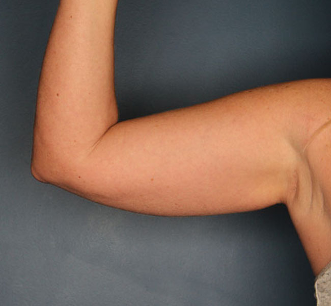 Case--38024 | Before Liposuction