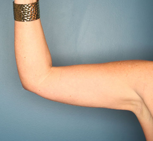 Case--38024 | After Liposuction