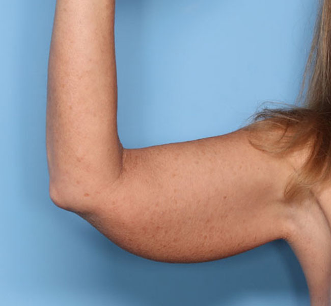 Case--38124 | Before Liposuction