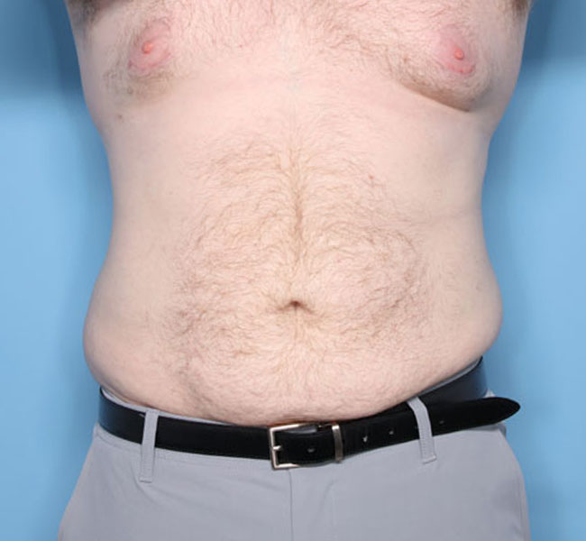 Case--38224 | After Liposuction