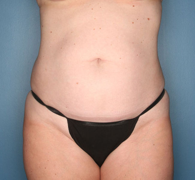 Case--38324 | Before Liposuction