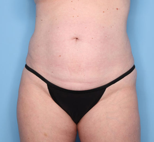 Case--38324 | After Liposuction
