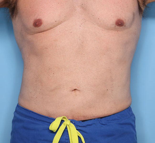 Case--38424 | After Liposuction