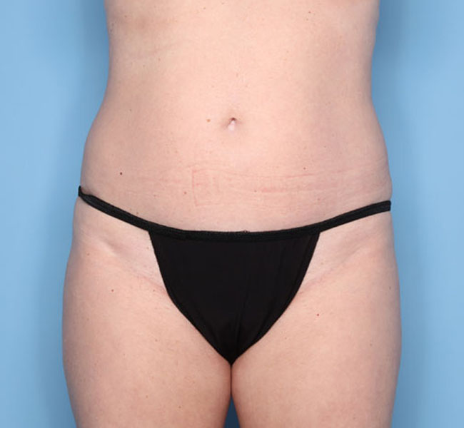 Case--38524 | Before Liposuction