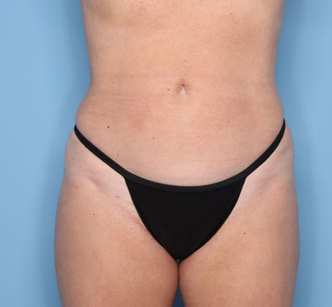 Case--38524 | After Liposuction