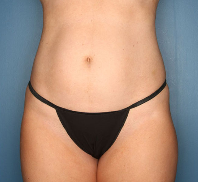 Case--38624 | Before Liposuction