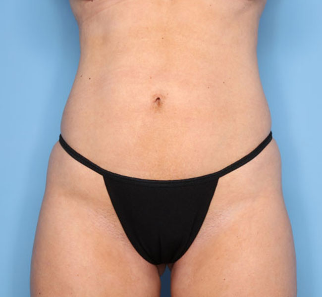 Case--38624 | After Liposuction