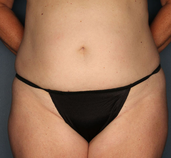 Case--38724 | Before Liposuction
