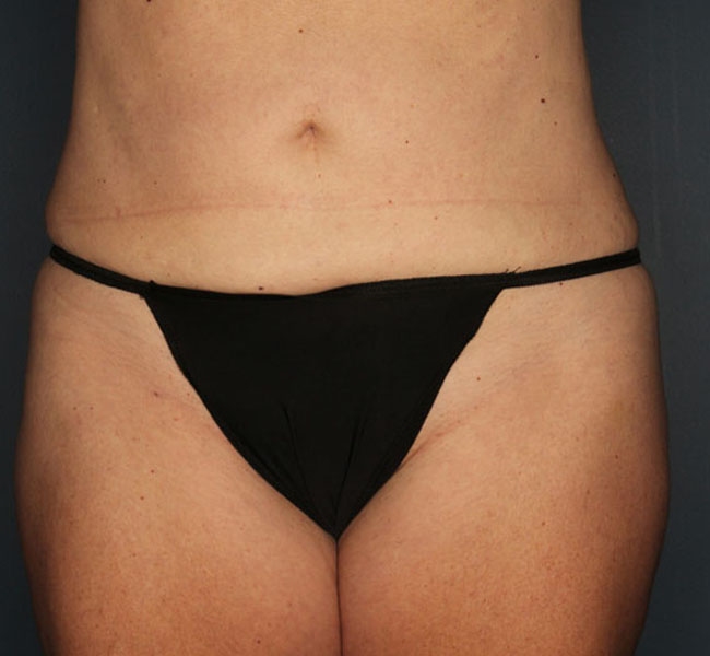 Case--38724 | After Liposuction