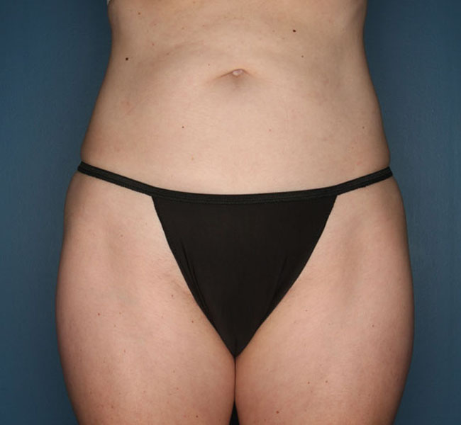 Case--38824 | After Liposuction