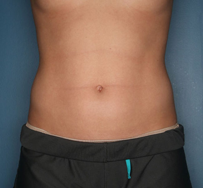 Case--38924 | Before Liposuction