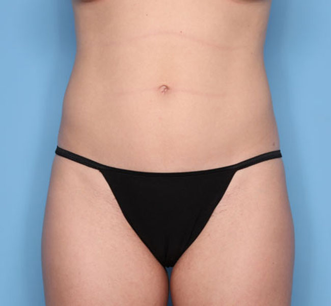 Case--38924 | After Liposuction