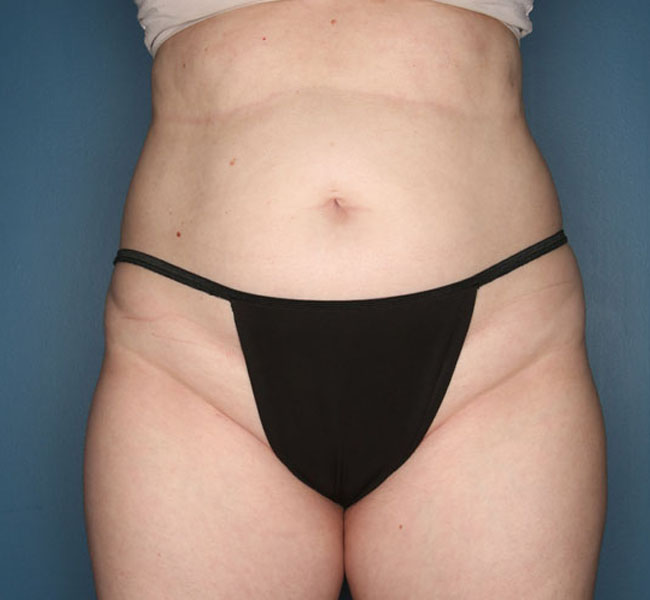 Case--39024 | Before Liposuction